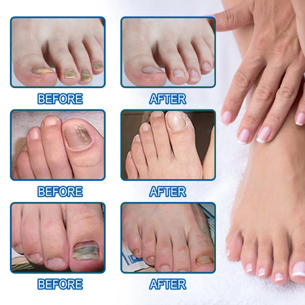 Box of 32 nail repair adhesive bandage patches for cracked nails, shown with one patch removed.