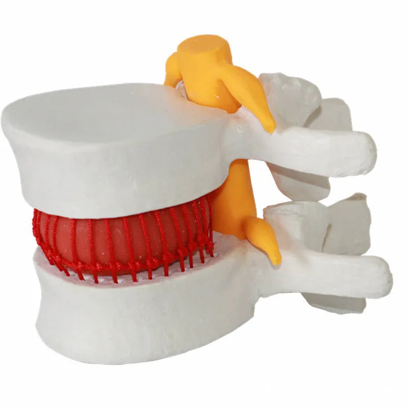 White PVC lumbar intervertebral disc demonstration model showing anatomical details