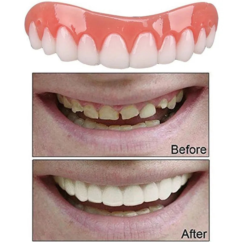 Removable cosmetic veneers for smile makeover, resizable to fit gapped and missing teeth