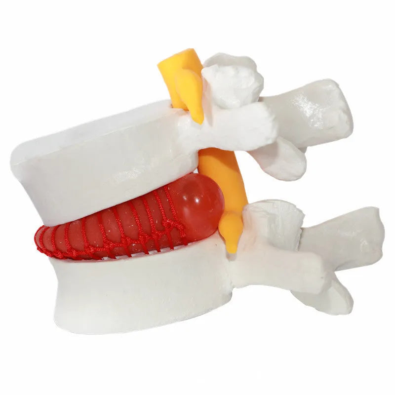 White PVC lumbar intervertebral disc demonstration model showing anatomical details