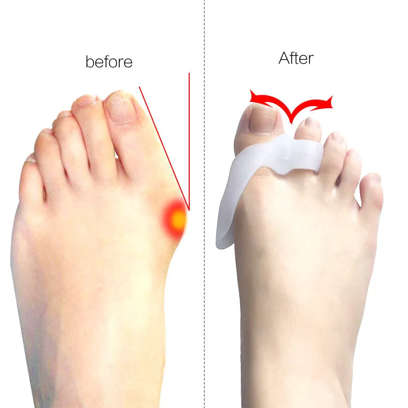 Silicone bunion corrector with double-hole SEBS toe separator for hallux valgus, in skin colour or white.