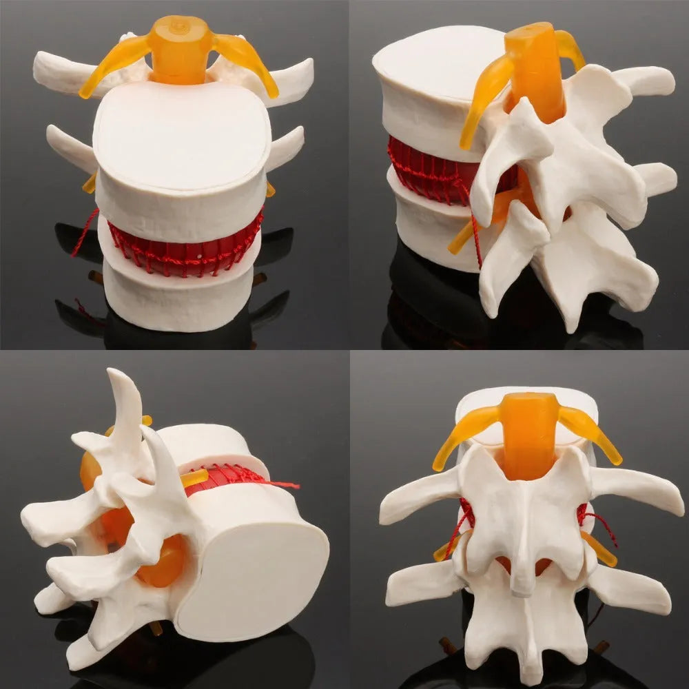 White PVC lumbar intervertebral disc demonstration model showing anatomical details