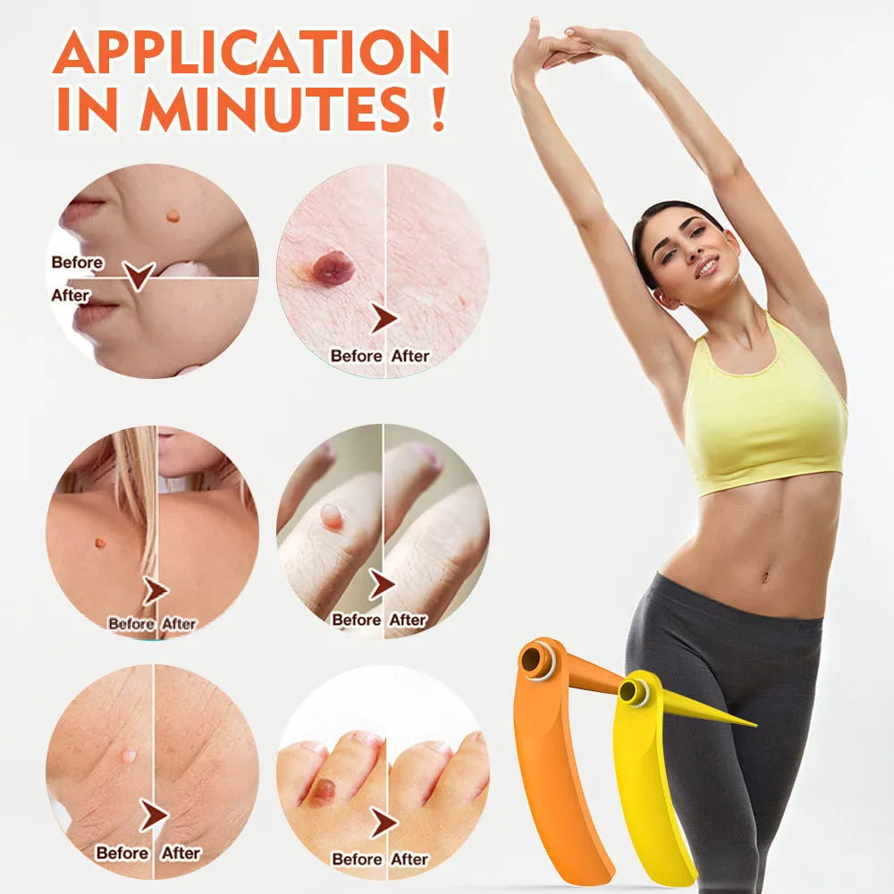 Orange-yellow mole remover tool kit with two devices, rubber rings, alcohol swabs and repair sticker